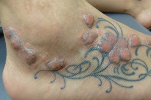 tattoo-allergia-parenergies